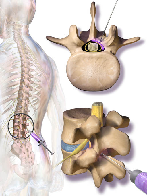 Epidural Steroid Injections