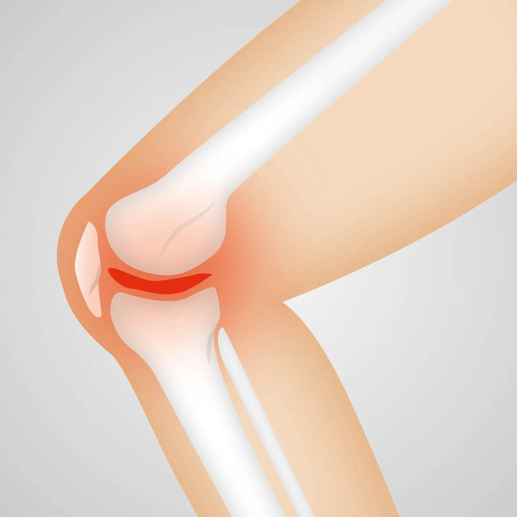 knee osteoarthritis