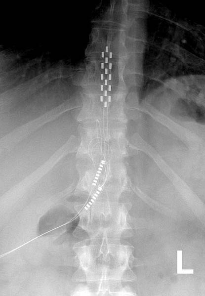 spinal cord stimulator Xray